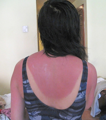 a sunburned back